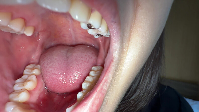 「【湊波流】素人お姉さんをナンパ！舌ブラシで汚舌苔採取する個人撮影動画」のサンプル画像9枚目